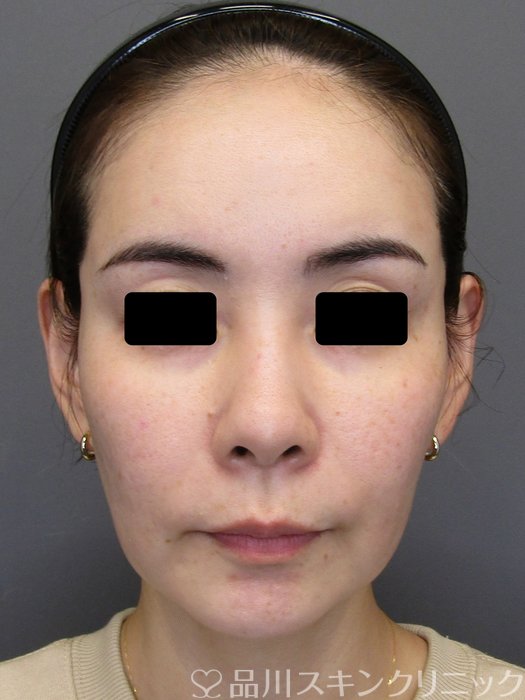症例NO.75184のBEFORE写真