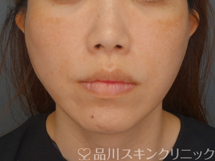 症例NO.74005のAFTER写真