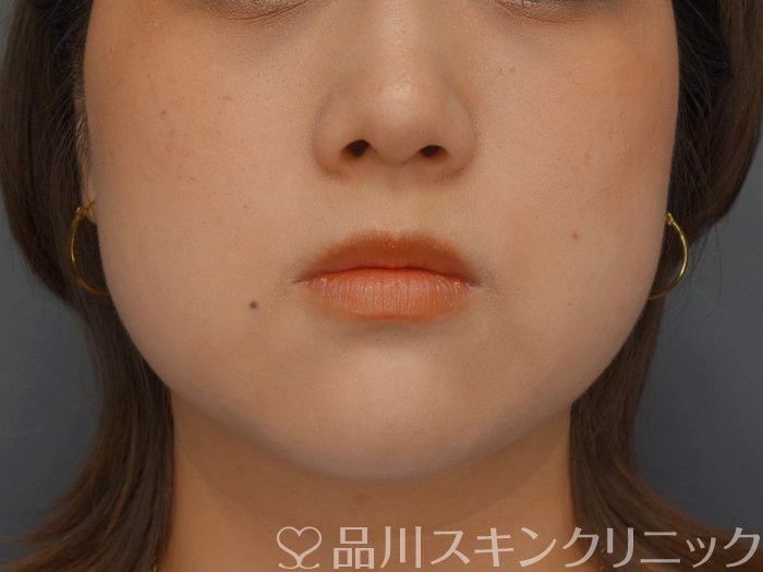 症例NO.74129のAFTER写真