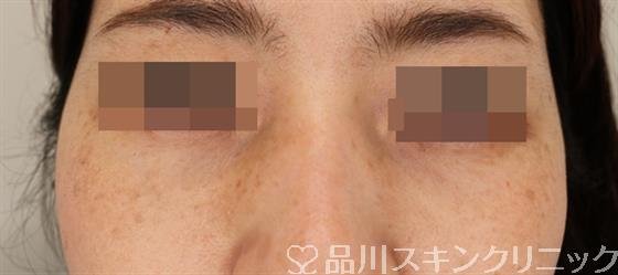 症例NO.50719のAFTER写真