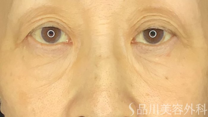 症例NO.69494のBEFORE写真