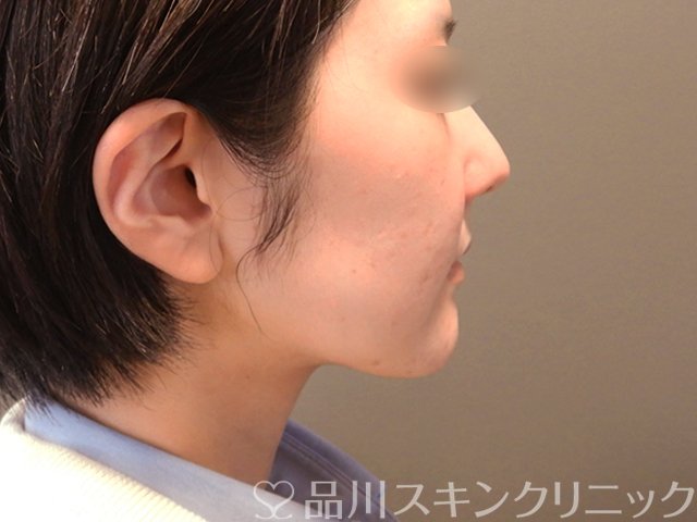 症例NO.65570のAFTER写真