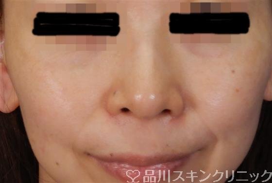 症例NO.60403のAFTER写真