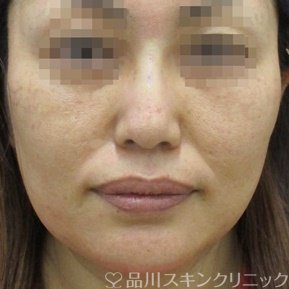症例NO.65105のAFTER写真