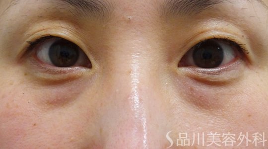 症例NO.72627のBEFORE写真