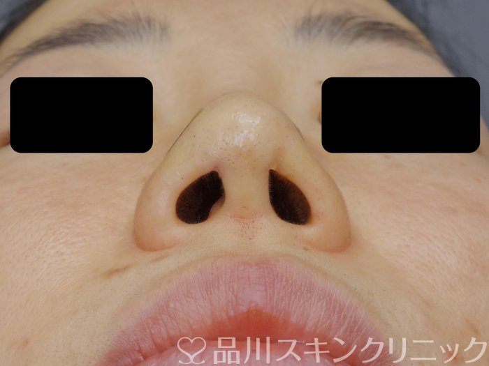 症例NO.71574のAFTER写真