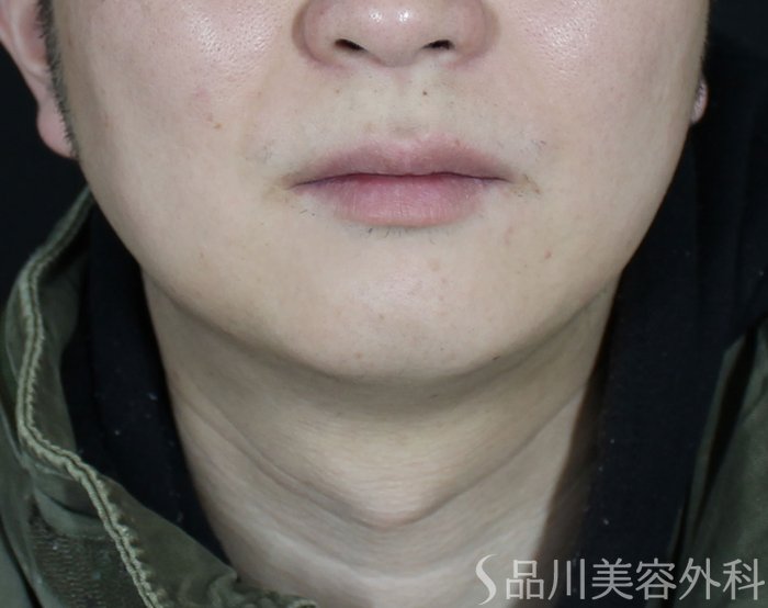 症例NO.69566のBEFORE写真