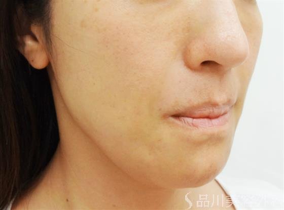 症例NO.30986のAFTER写真