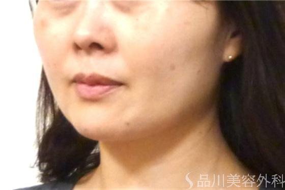 症例NO.16878のBEFORE写真