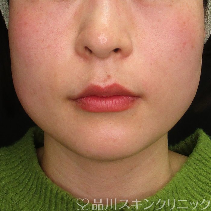 症例NO.70082のBEFORE写真