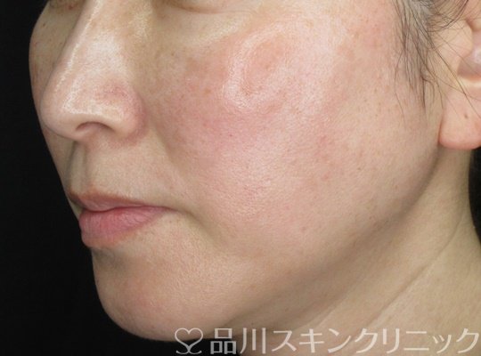 症例NO.70364のAFTER写真