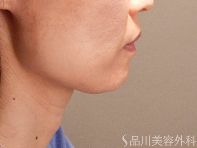 症例NO.70676のBEFORE写真
