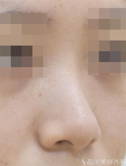 症例NO.44619のBEFORE写真