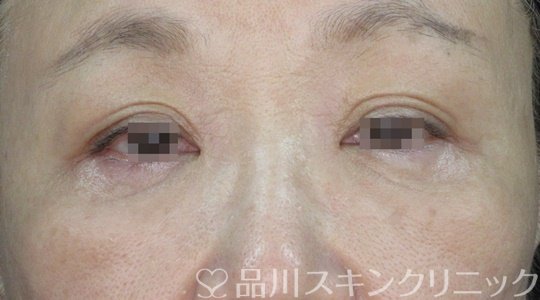 症例NO.71465のAFTER写真