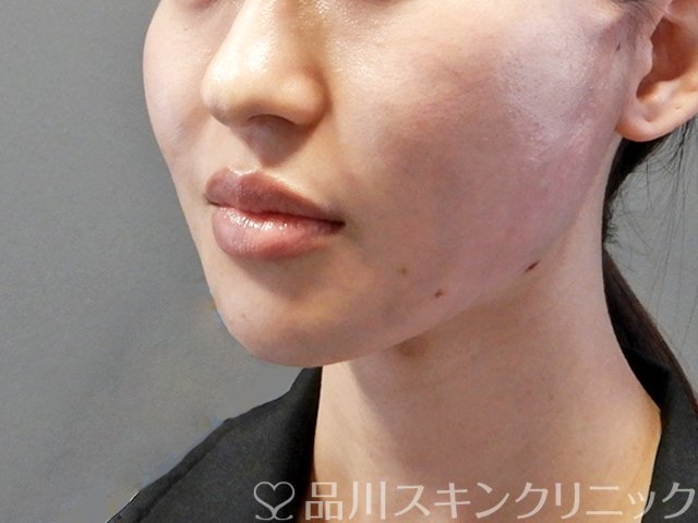 症例NO.64384のAFTER写真