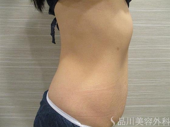 症例NO.20811のAFTER写真