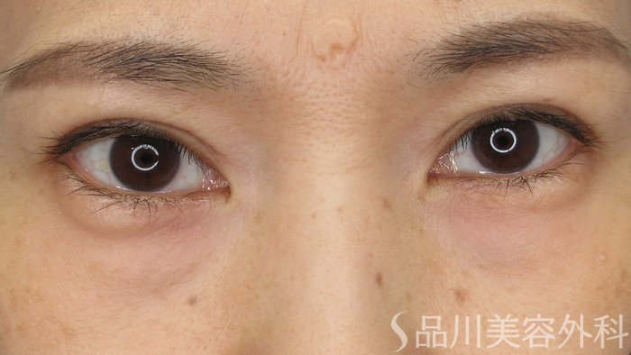 症例NO.66116のAFTER写真