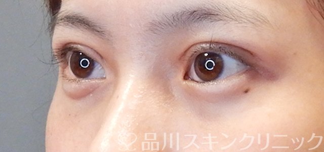 症例NO.67717のAFTER写真