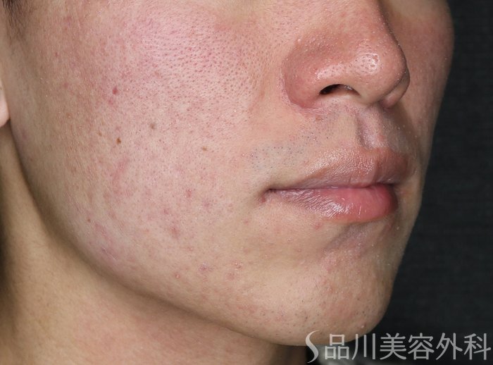 症例NO.70557のBEFORE写真