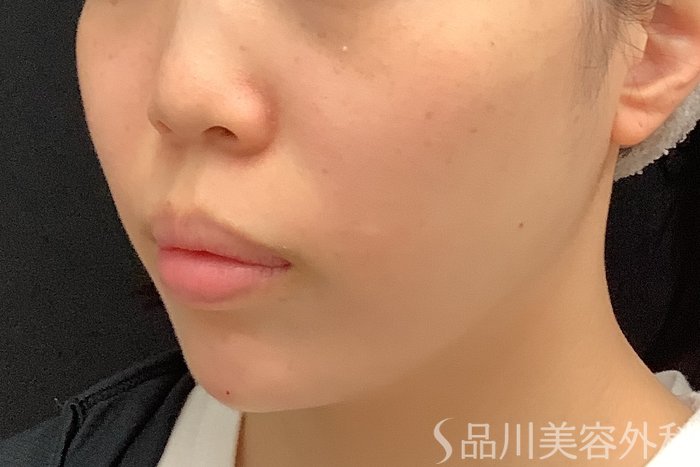 症例NO.71585のAFTER写真