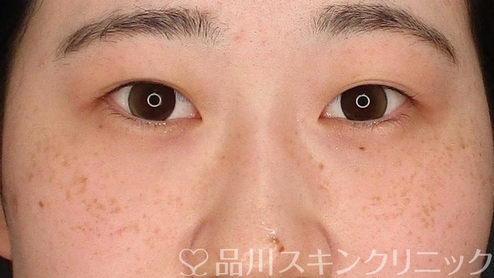 症例NO.62723のBEFORE写真