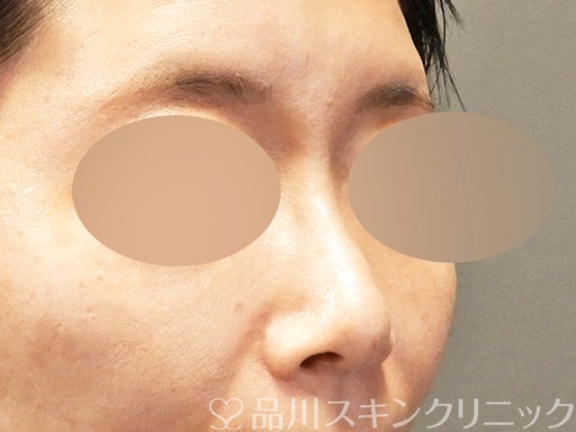 症例NO.68927のAFTER写真