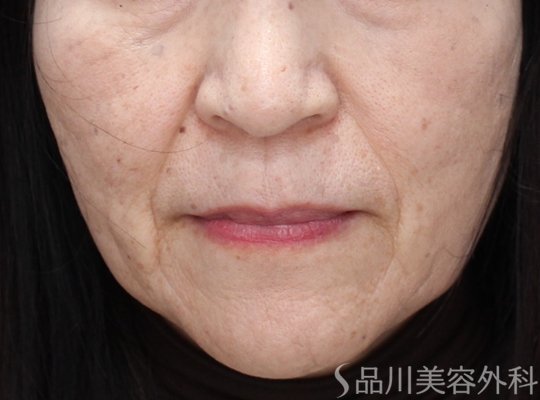 症例NO.73504のBEFORE写真