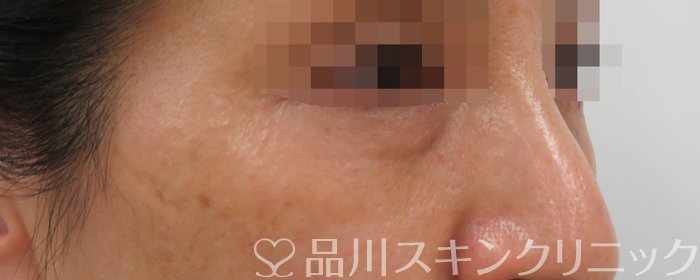 症例NO.63037のBEFORE写真