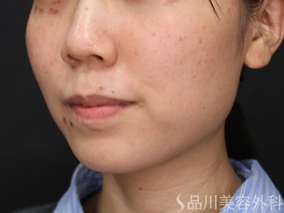 症例NO.75156のBEFORE写真
