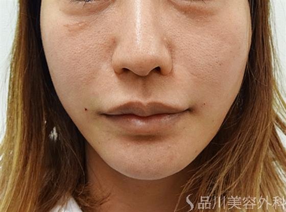 症例NO.34408のAFTER写真