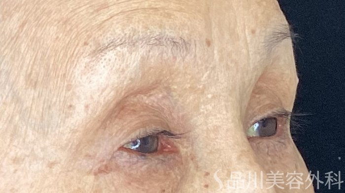 症例NO.69511のBEFORE写真