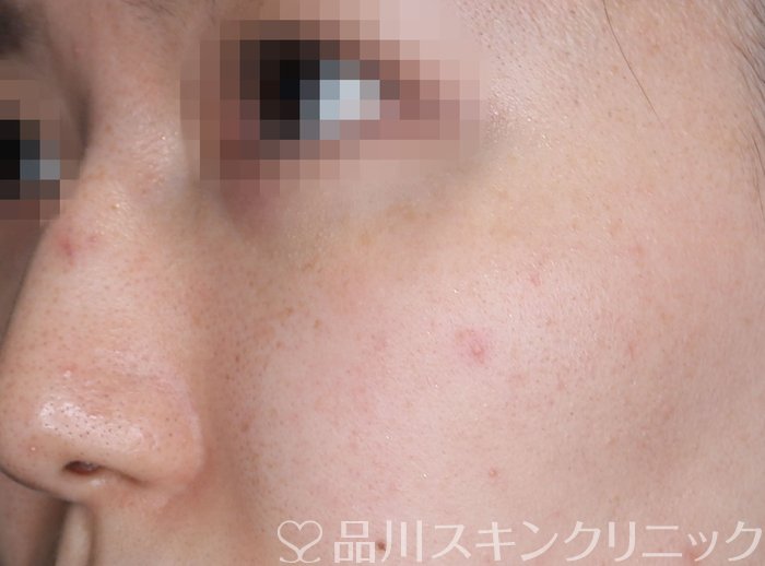 症例NO.73495のAFTER写真