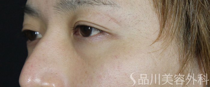 症例NO.72012のBEFORE写真