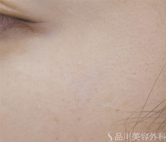 症例NO.55267のAFTER写真