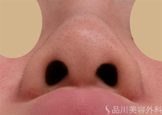 症例NO.27814のAFTER写真