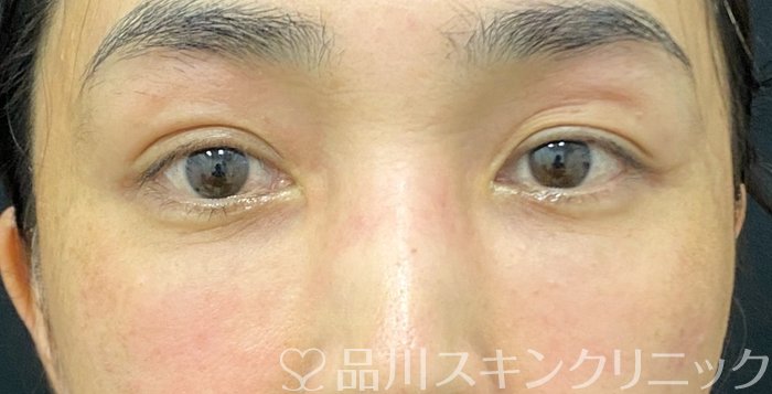 症例NO.75199のAFTER写真
