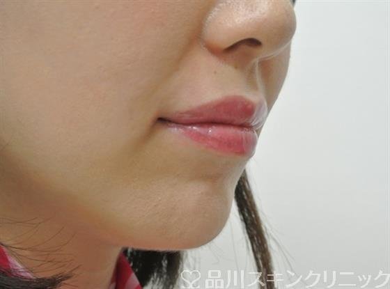 症例NO.27307のAFTER写真