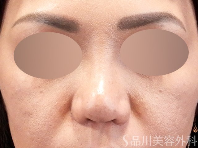 症例NO.67918のAFTER写真