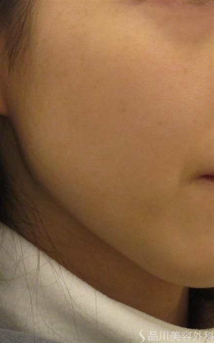 症例NO.58871のAFTER写真