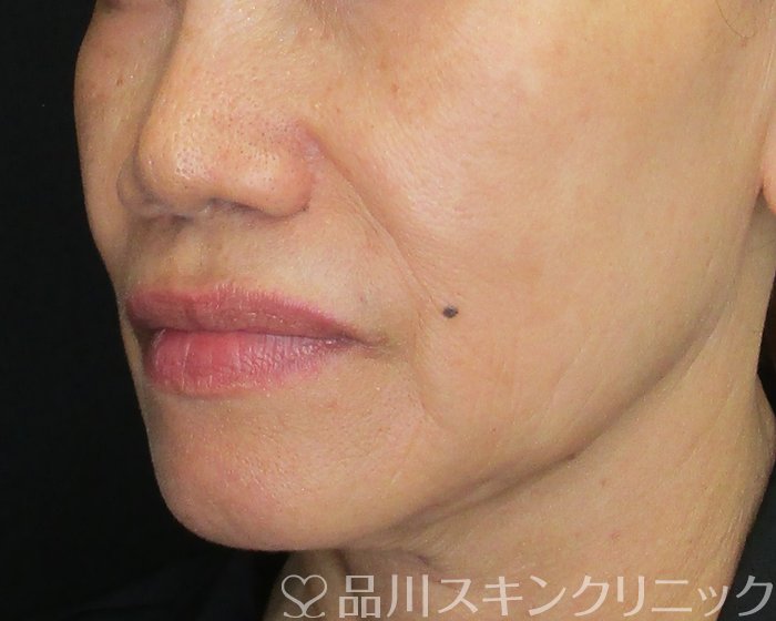症例NO.74947のBEFORE写真