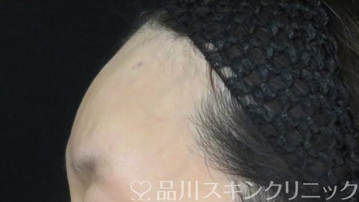 症例NO.71331のAFTER写真
