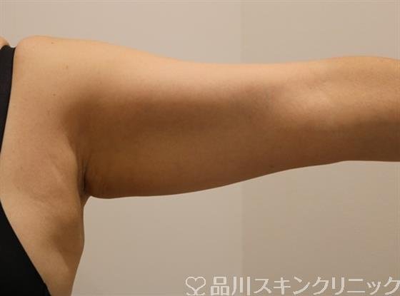 症例NO.44581のBEFORE写真
