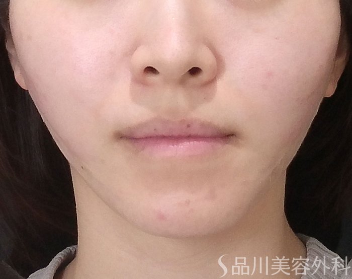 症例NO.65392のAFTER写真