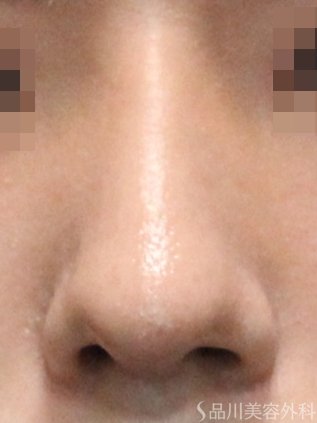 症例NO.75215のAFTER写真