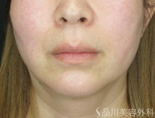 症例NO.73251のAFTER写真