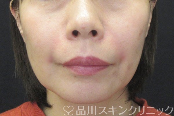 症例NO.67376のAFTER写真
