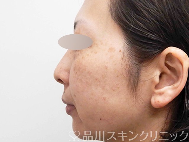 症例NO.69019のBEFORE写真