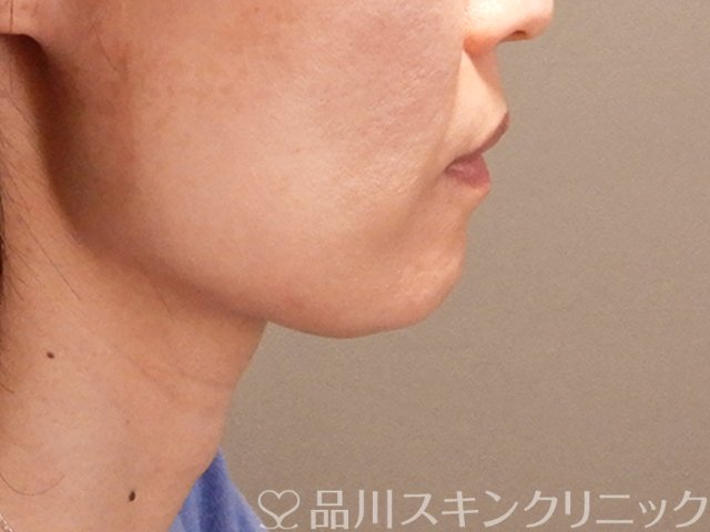 症例NO.70676のBEFORE写真