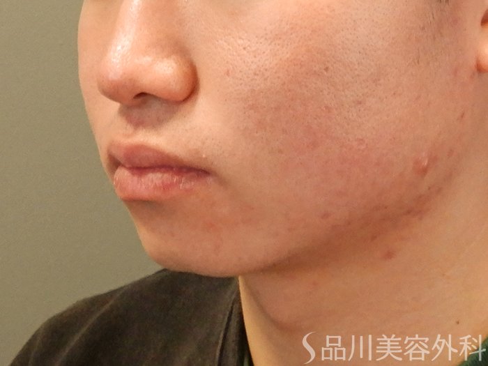 症例NO.69691のBEFORE写真