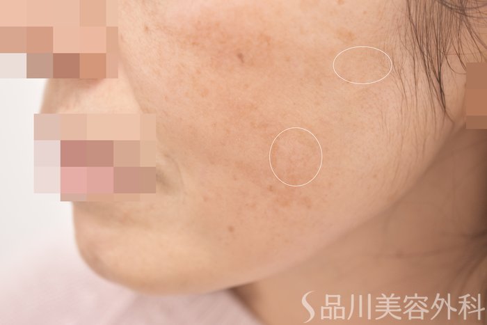 症例NO.64711のAFTER写真